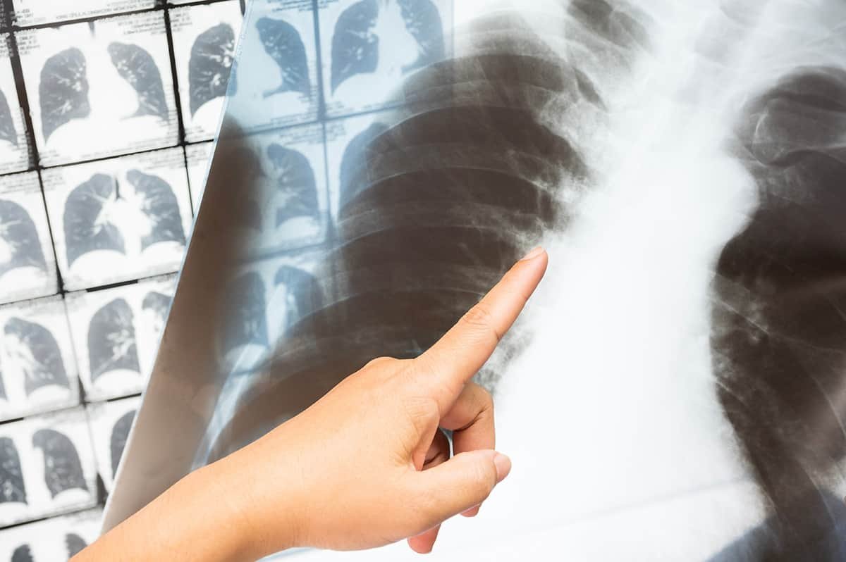 chest-xray-and-ct-scan-1702169713-Shutterstock_Komsan-Loonprom